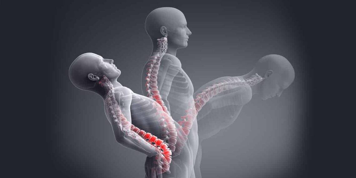 Bel Tutulması (Lomber Faset Sendromu)