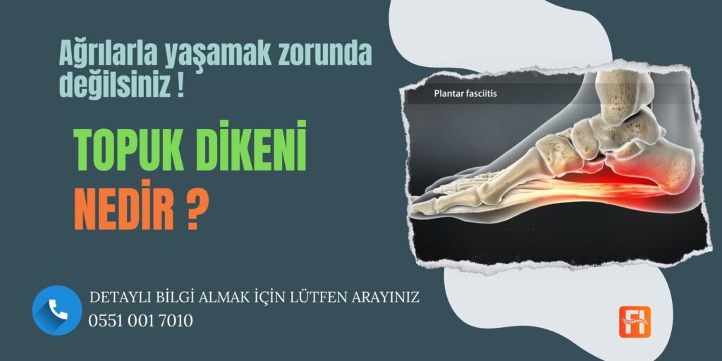 Topuk Dikeni (Calcaneal Spur)