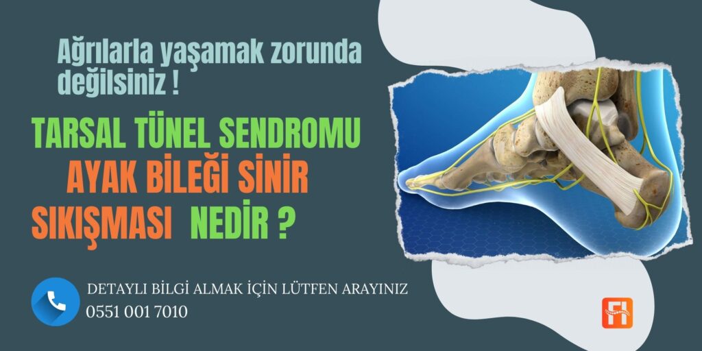 Tarsal Tünel Sendromu (Ayak Bileği Sinir Sıkışması)