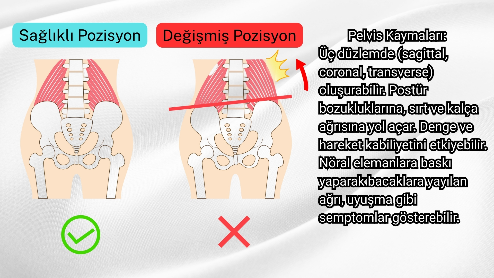 pelvis kayması leğen kemiği pozisyon değişikliği